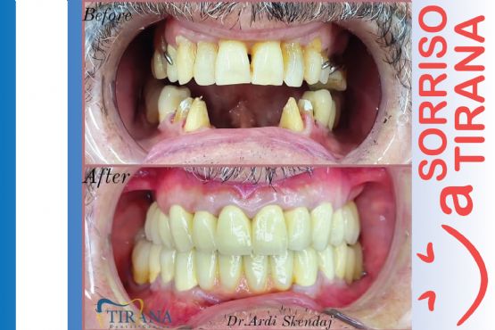 Denti in zirconio, denti in zirconio pro e contro, denti in zirconio prezzi i denti in zirconio ingialliscono, denti in zirconio si macchiano, denti in zirconio prima e dopo denti in zirconio o ceramica